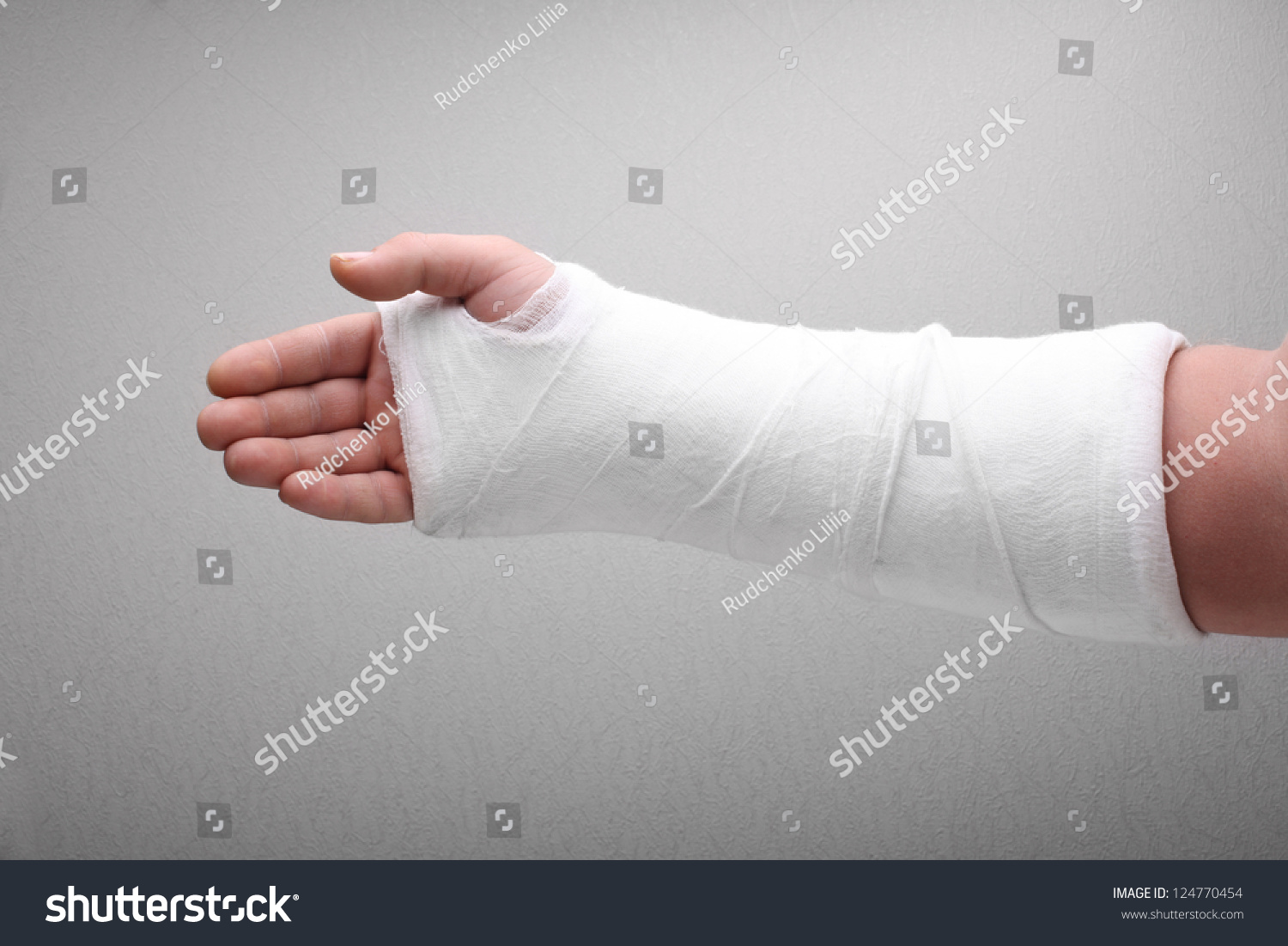 Powerpoint Template Bone Fracture Broken Arm Ijloohlml 9102