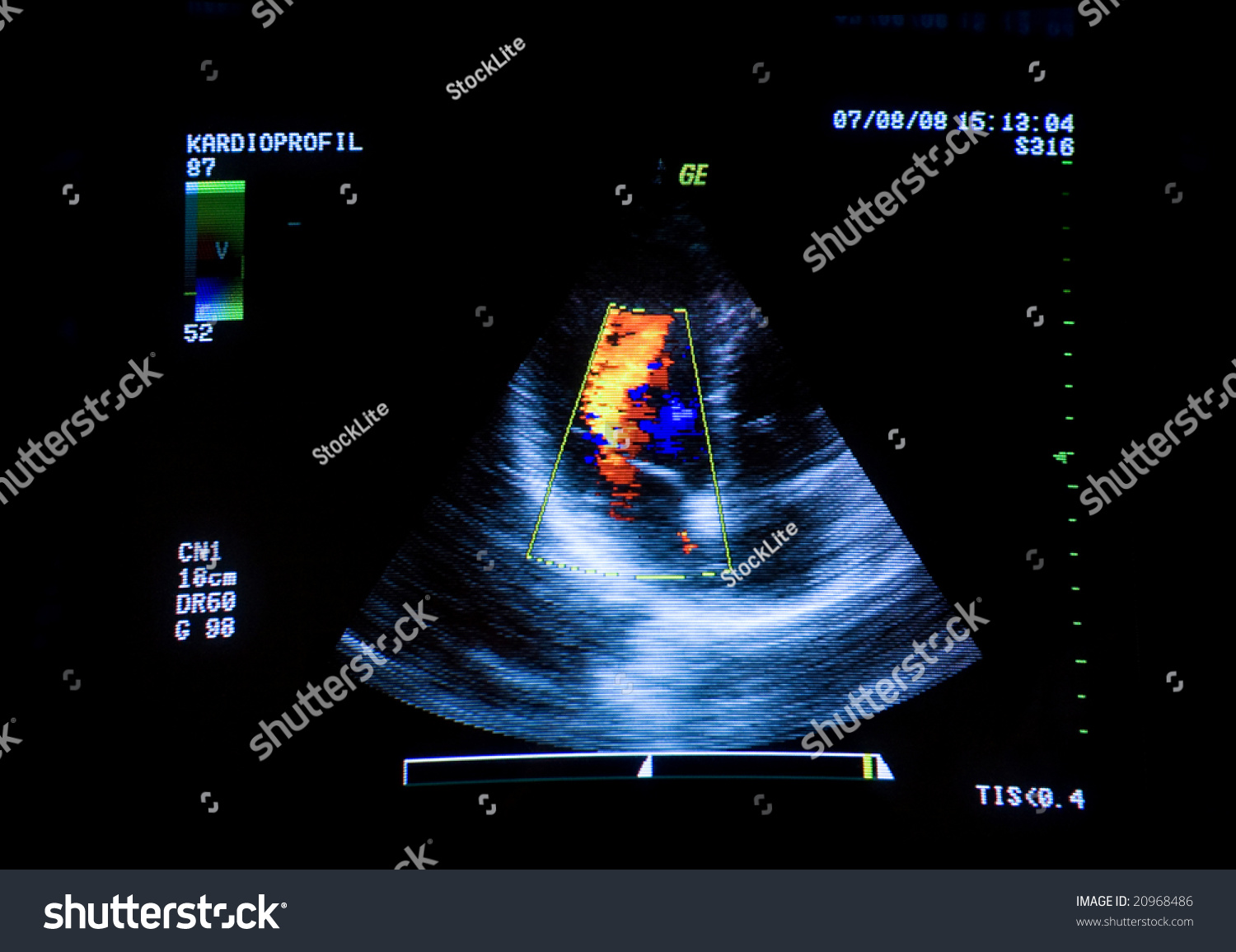 heart sonogram