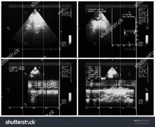 PowerPoint Template: echocardiography heart valve - medical (lhmlnmljl)